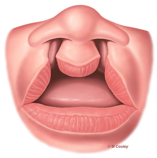 Michael A. Cooley, Bilateral Cleft Lip 1a, 2011, Digital, Publication, Nationwide Children’s Hospital. This is one in a series of illustrations depicting diagnosis and treatment of a bilateral cleft lip.