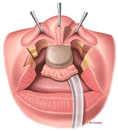 Michael A. Cooley, Bilateral Cleft Lip 1c, 2011, Digital, Publication, Nationwide Children’s Hospital.