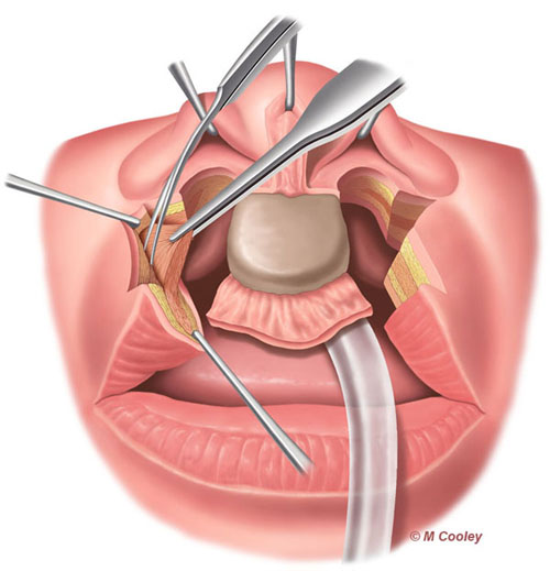 Michael A. Cooley, Bilateral Cleft Lip 1d, 2011, Digital, Publication, Nationwide Children’s Hospital.