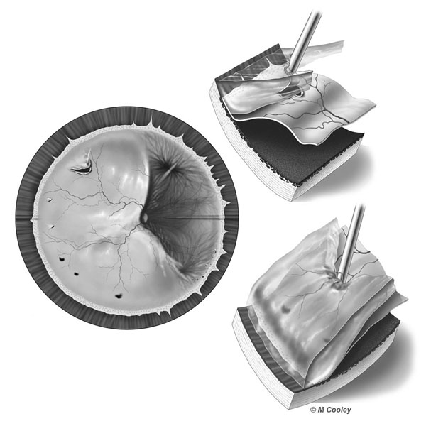 Michael A. Cooley, Detached Retina, 2004, Digital Tone. This illustration depicts a detached retina and treatment via vitrectomy. These illustrations were create for patient education for Dr. Rex Hawkins of Retina Vitreous Associates in Houston Texas.
