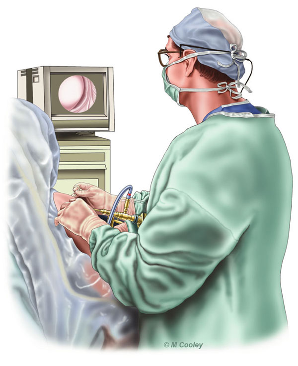 Michael A. Cooley, Orthopedic Surgeon, 2002, Digital Color. This illustration depicts an Orthopedic Surgeon working on the right glenohumeral joint (shoulder) of his patient.