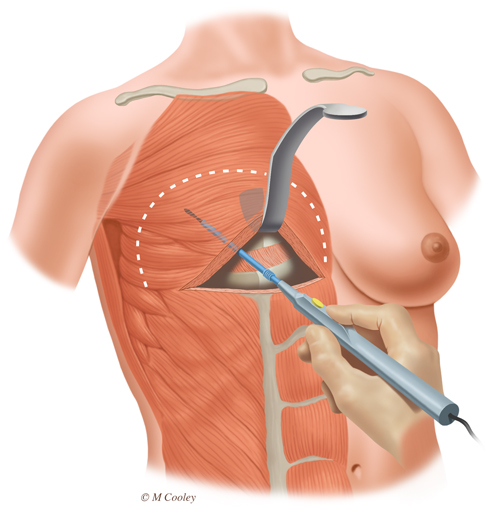 Breast Reconstruction Figure 1, Digital, 2015