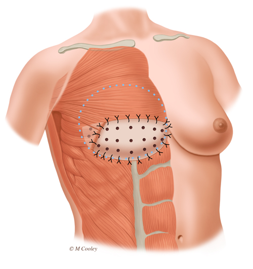 Michael A. Cooley, Breast Reconstruction Figure 2, Digital, 2015