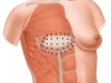 Breast Reconstruction Figure 2