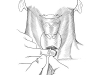 ThyroidectomyIncision