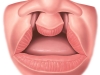 Bilateral Cleft Lip Dx