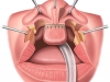 Bilateral Cleft Lip Rx