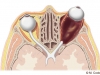 Lymphatic Malformation Dx