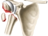 TSA Prosthesis (3 part HH fx)