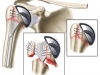 TSA Prosthesis (3 part HH Rx)